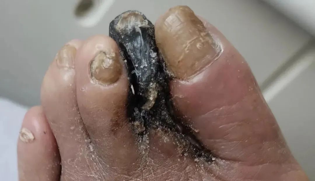 痴呆老人脚趾变「黑炭」!脚疼、发凉,警惕「腿梗」