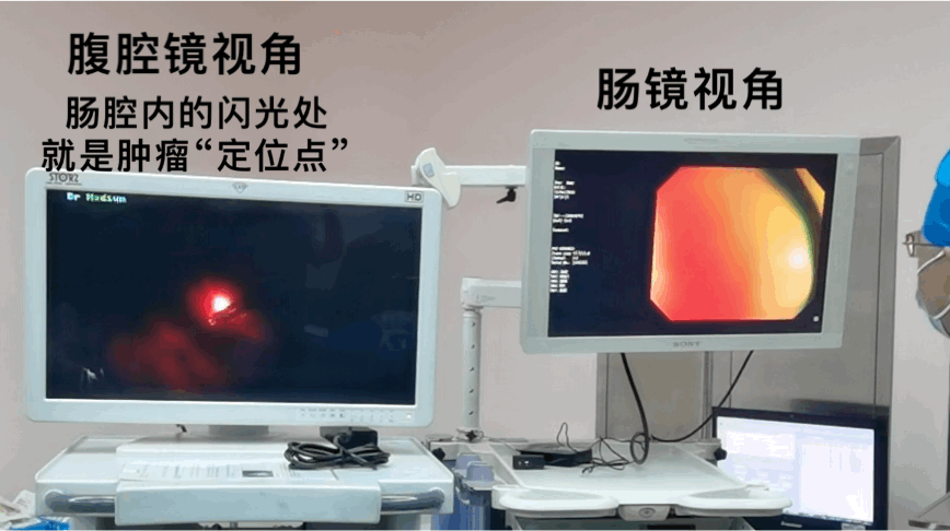 外科、内镜中心联手「拿下」癌症!肠癌「露马脚」的 3 个信号要警惕!