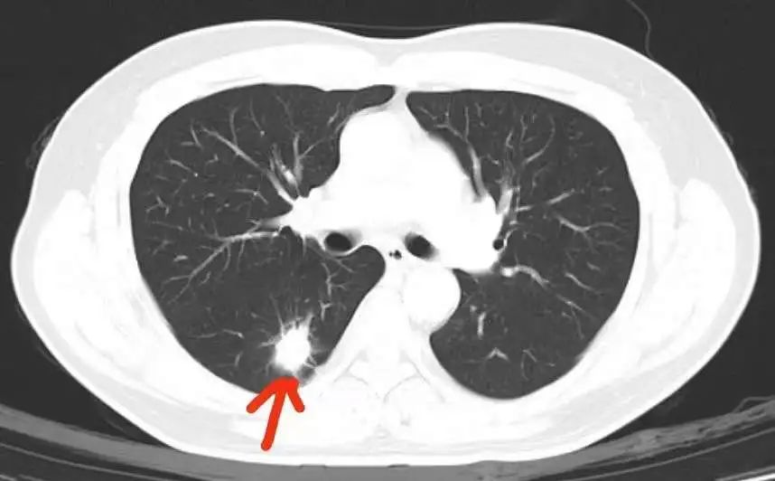 肿瘤标记物明显升高意味着什么?有效的肿瘤早筛应该这样做