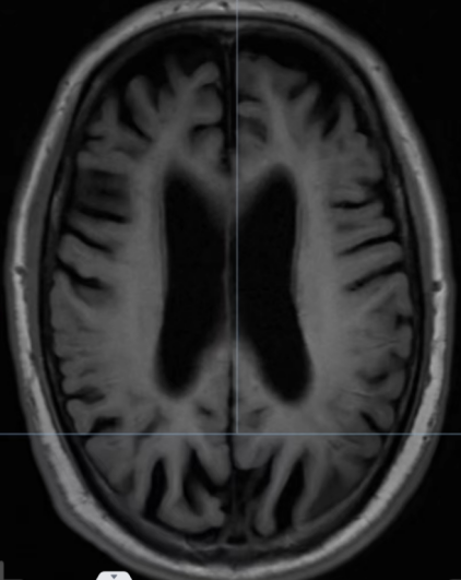 要花 5 年才能确诊的怪病？这个团队凭一张影像，不到一周就破案