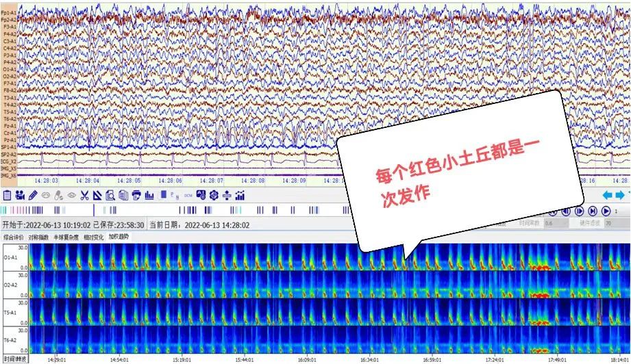 没有抽搐也能称为癫痫发作?
