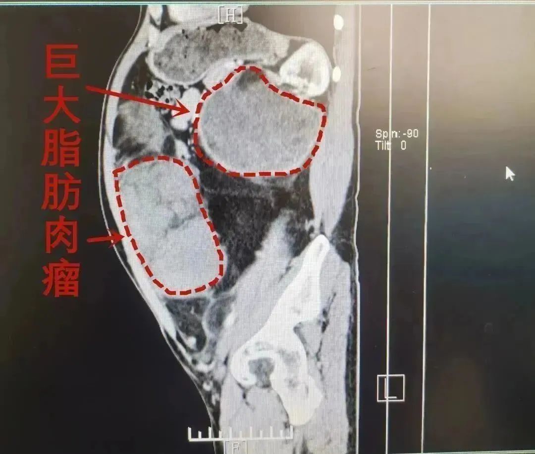 诏安一男子肚大如孕妇，医生从他肚里捧出近 10 斤的「肉团」