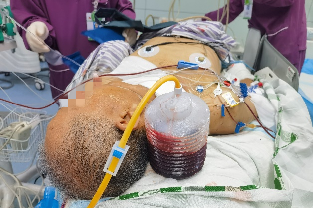 广西中医药大学第一附属医院成功救治一位肝硬化门静脉高压伴消化道大出血休克患者