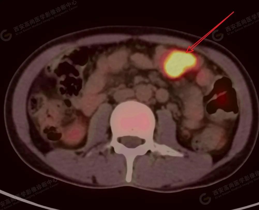 【高尚病例】同时多发大肠癌——肠镜发现 3 处病灶，PET/CT 发现 10 多处病灶。