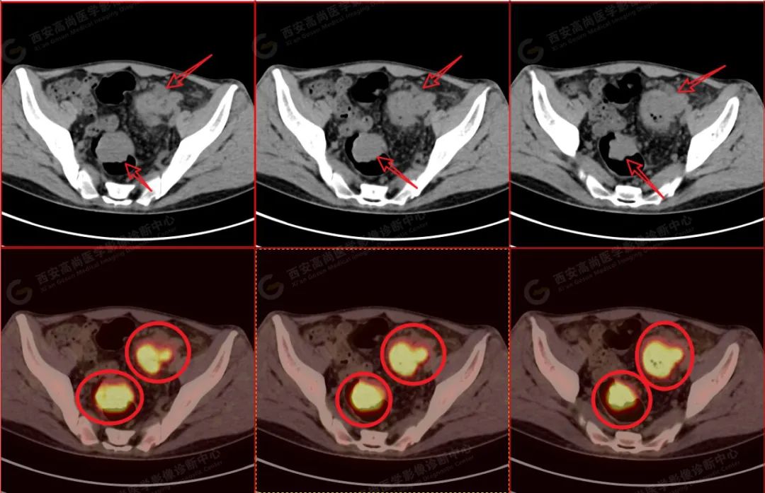 【高尚病例】同时多发大肠癌——肠镜发现 3 处病灶，PET/CT 发现 10 多处病灶。