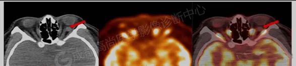 【高尚病例】右眼流泪 3+月,PET/CT 诊断眼球黑色素瘤