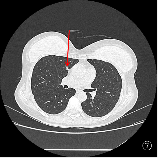 口咽癌术后 10 月肺转移,重庆松山医院肿瘤科精准介入诊断