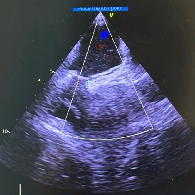 七旬老人突发脑梗、呼吸衰竭，竟因心脏多了一个「孔」！