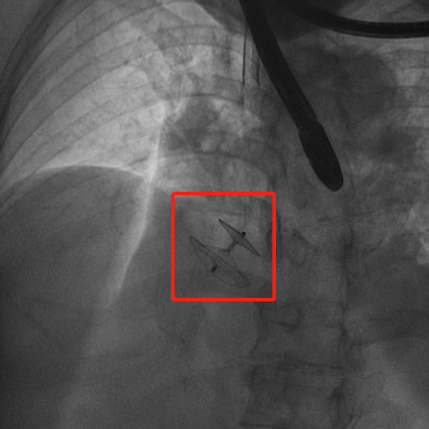 七旬老人突发脑梗、呼吸衰竭，竟因心脏多了一个「孔」！
