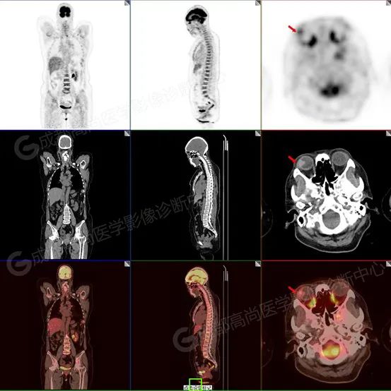 【高尚病例】右眼流泪 3+月,PET/CT 诊断眼球黑色素瘤