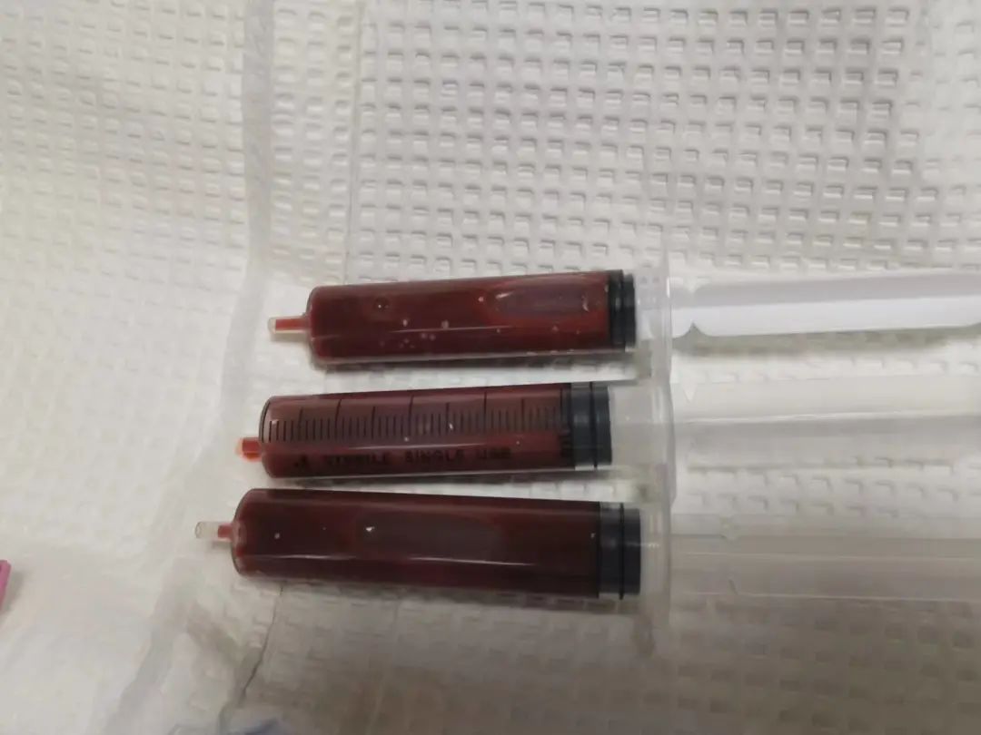 「气」出来的大疙瘩，看河南省肿瘤医院专家上演肿物「消失术」