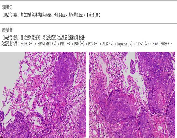 口咽癌术后 10 月肺转移,重庆松山医院肿瘤科精准介入诊断