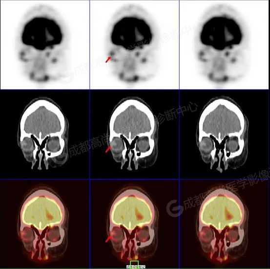 【高尚病例】右眼流泪 3+月,PET/CT 诊断眼球黑色素瘤