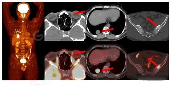 【高尚病例】右眼流泪 3+月,PET/CT 诊断眼球黑色素瘤
