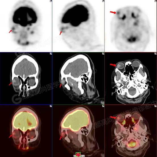 【高尚病例】右眼流泪 3+月,PET/CT 诊断眼球黑色素瘤