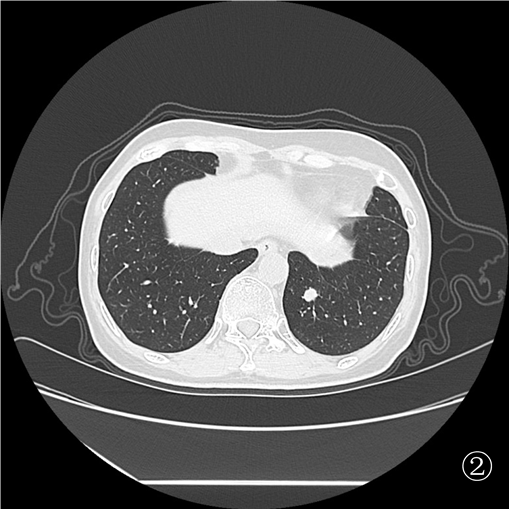 口咽癌术后 10 月肺转移,重庆松山医院肿瘤科精准介入诊断