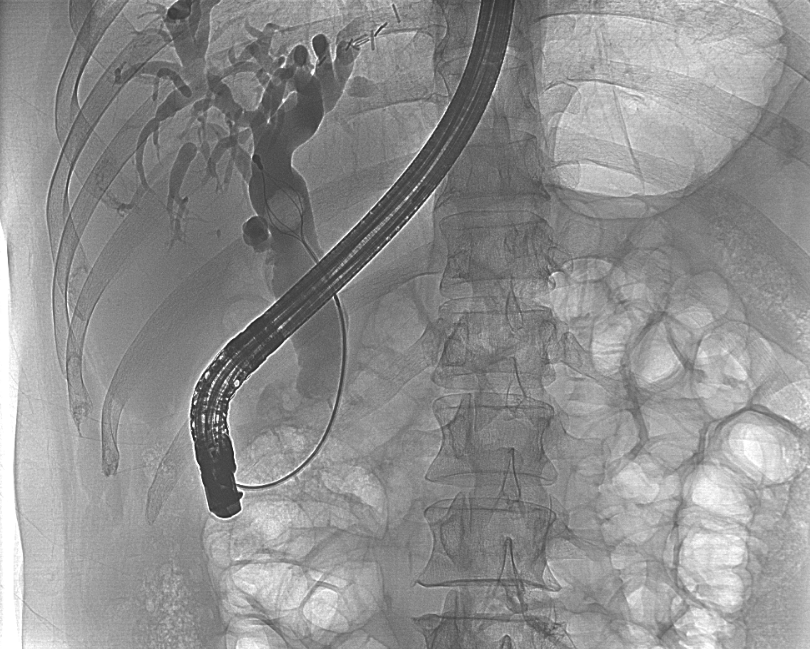 9 年 4 次胆道手术，男子胆管结石反复发作，关键时刻 ERCP 来救命！