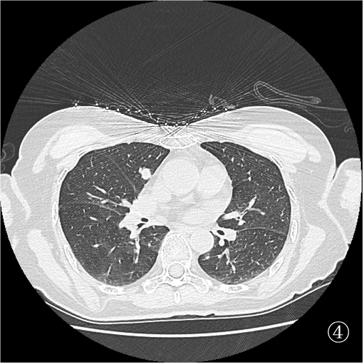 口咽癌术后 10 月肺转移,重庆松山医院肿瘤科精准介入诊断