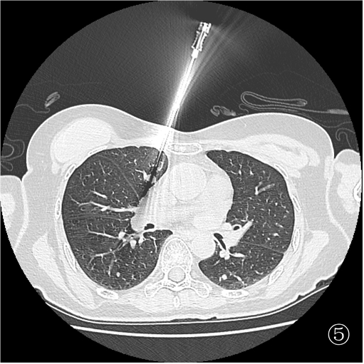 口咽癌术后 10 月肺转移,重庆松山医院肿瘤科精准介入诊断