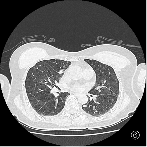 口咽癌术后 10 月肺转移,重庆松山医院肿瘤科精准介入诊断