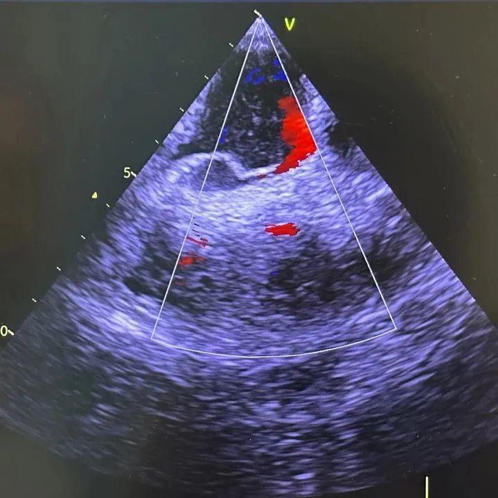 七旬老人突发脑梗、呼吸衰竭，竟因心脏多了一个「孔」！