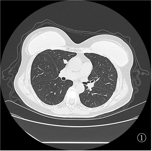 口咽癌术后 10 月肺转移,重庆松山医院肿瘤科精准介入诊断