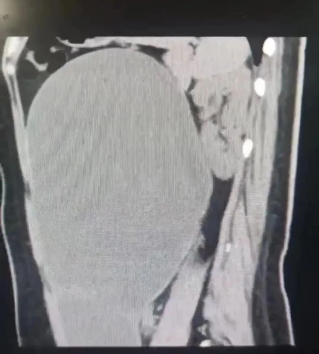 23 岁女孩莫名大肚以为长胖,医生:肚子里有个「大水球」