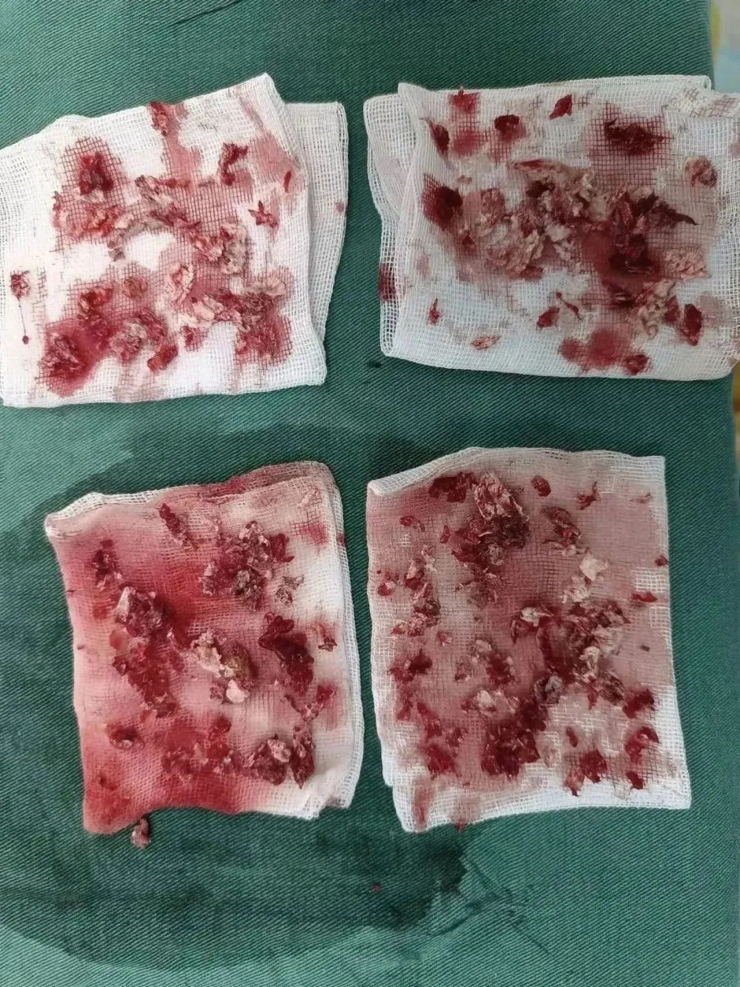 惊悚 | 湖南男子被一「枪」打中,医生直接挖穿掌心!