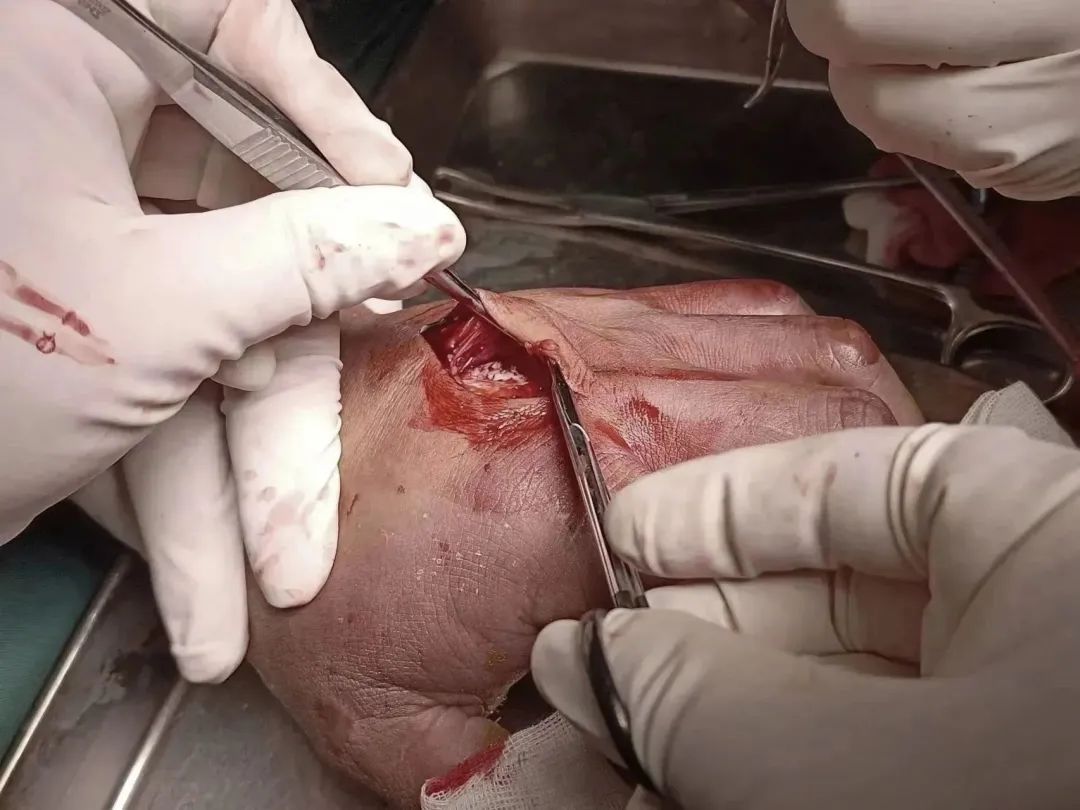 惊悚 | 湖南男子被一「枪」打中,医生直接挖穿掌心!