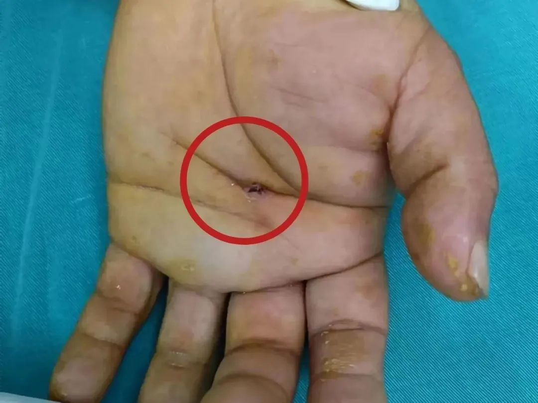 惊悚 | 湖南男子被一「枪」打中,医生直接挖穿掌心!