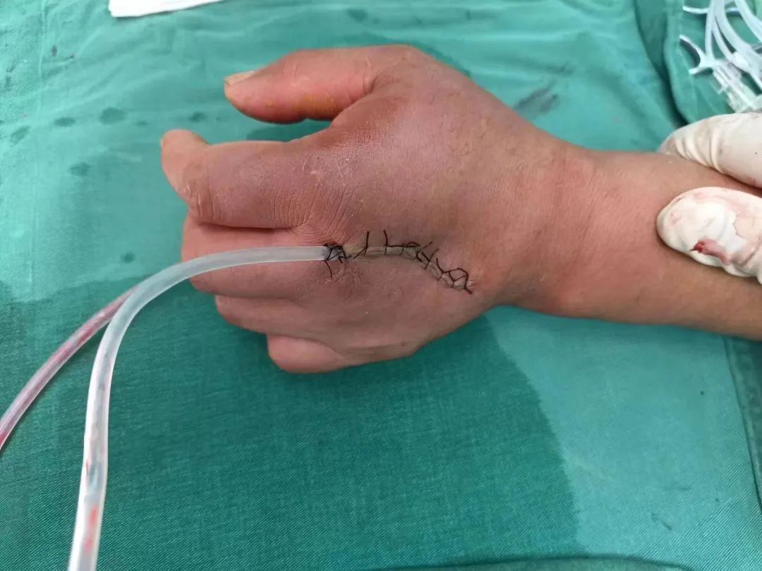 惊悚 | 湖南男子被一「枪」打中,医生直接挖穿掌心!