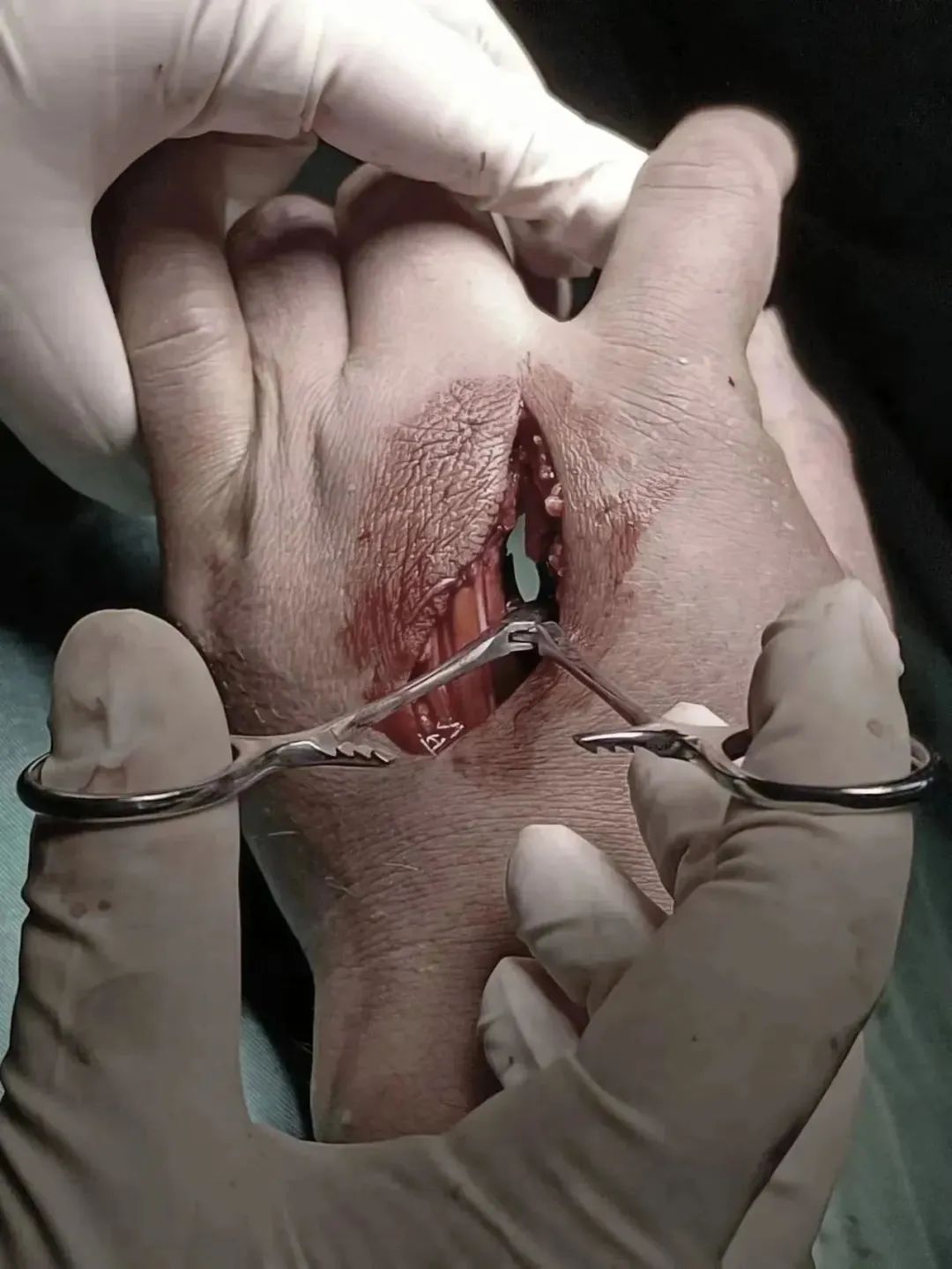 惊悚 | 湖南男子被一「枪」打中,医生直接挖穿掌心!