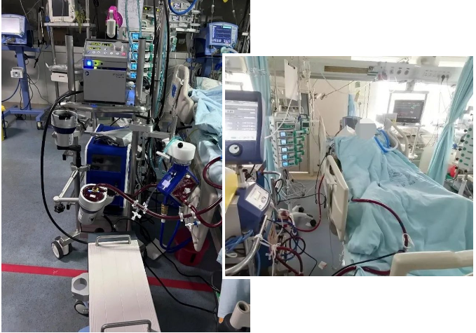 桂林医学院附属医院 3 台 ECMO 同时运转完成极限抢救