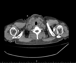 10 cm！「掐」住气管的巨大甲状腺肿瘤被成功切除！