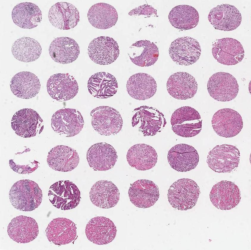 IWLT-N-84B92乳腺癌与癌旁组织芯片