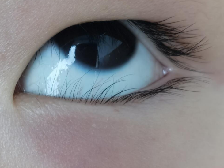 做作业「不认真」？可能是倒睫惹的祸