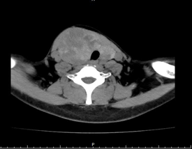 10 cm！「掐」住气管的巨大甲状腺肿瘤被成功切除！