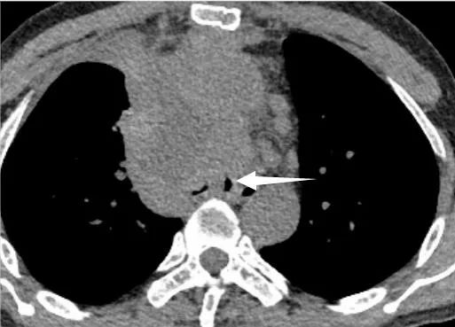 从严重窒息到自由呼吸:桂林医学院附属医院呼吸科顺利实施 ECMO 支持下气道支架置入术