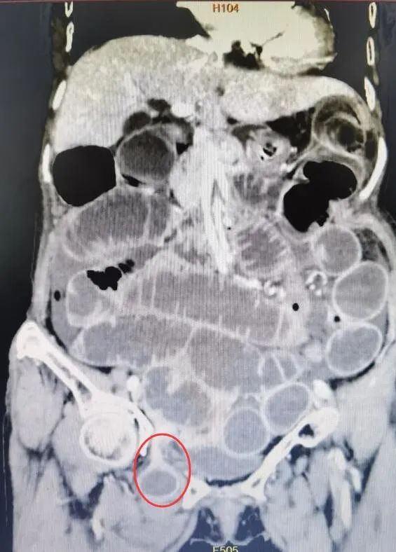桂林一老太大腿根部疼痛,桂林医学院附属医院胃肠外科为其解决「隐秘杀手」