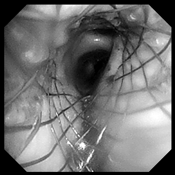 从严重窒息到自由呼吸:桂林医学院附属医院呼吸科顺利实施 ECMO 支持下气道支架置入术