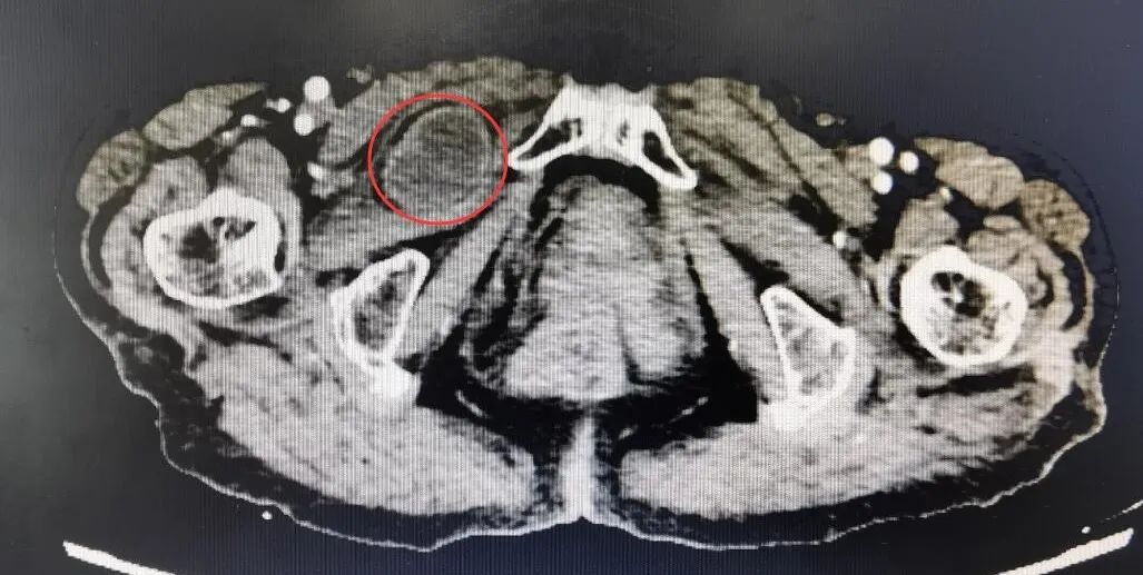 桂林一老太大腿根部疼痛,桂林医学院附属医院胃肠外科为其解决「隐秘杀手」