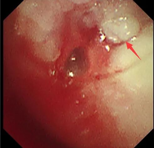 从严重窒息到自由呼吸:桂林医学院附属医院呼吸科顺利实施 ECMO 支持下气道支架置入术