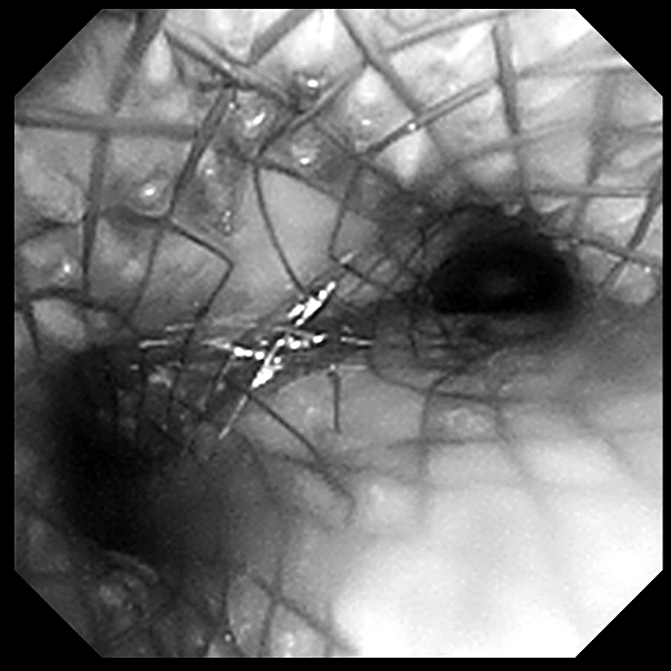 从严重窒息到自由呼吸:桂林医学院附属医院呼吸科顺利实施 ECMO 支持下气道支架置入术