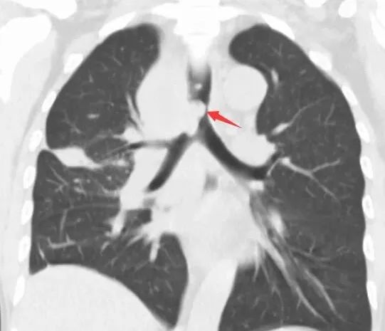从严重窒息到自由呼吸:桂林医学院附属医院呼吸科顺利实施 ECMO 支持下气道支架置入术