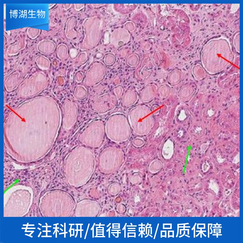 HCC 38人乳腺导管癌细胞