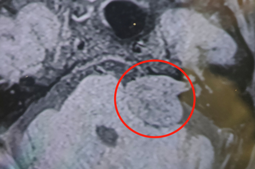 耳鸣、听不清?可能是脑子里的肿瘤在「作怪」