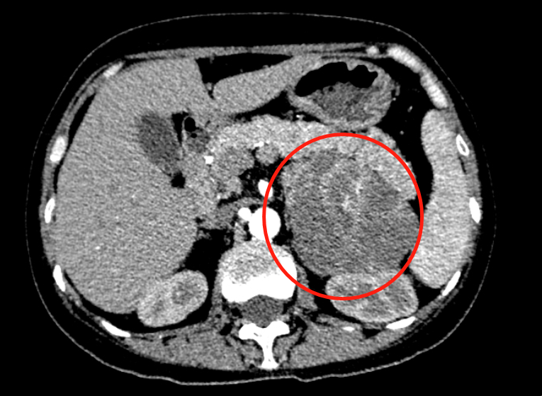 全身无力难查因 抽丝剥茧「揪」元凶——发挥多学科优势，南方医科大学顺德医院沈洁教授团队助力一名肿瘤患者实现早诊早治