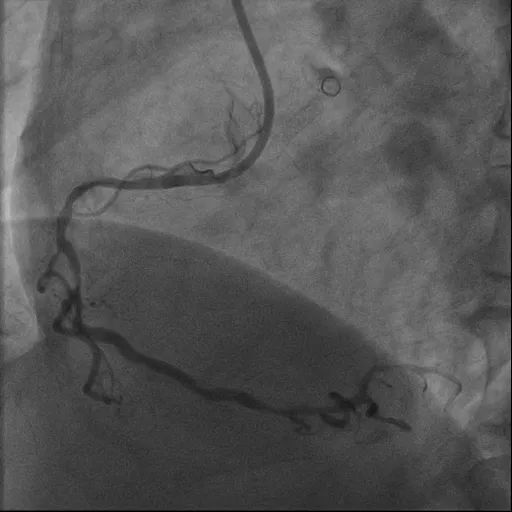 心脏血管长「石头」？重庆松山医院首例「冲击波球囊技术」打通生命通道