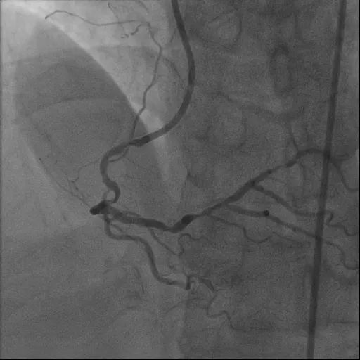 心脏血管长「石头」？重庆松山医院首例「冲击波球囊技术」打通生命通道