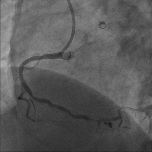 心脏血管长「石头」？重庆松山医院首例「冲击波球囊技术」打通生命通道